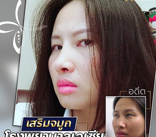 เสริมจมูกแบบโอเพ่น-rhinoplasty