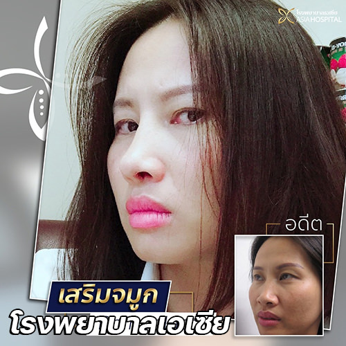 เสริมจมูกแบบโอเพ่น-rhinoplasty